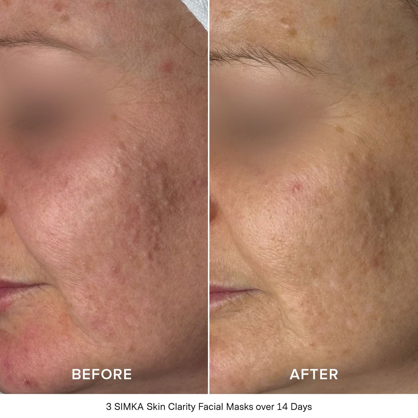 Skin Clarity Bio-Cellulose Facial Mask (4 Pack)